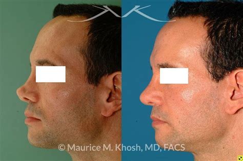 New York Rhinoplasty Revision Surgery Maurice M Khosh Md Facs