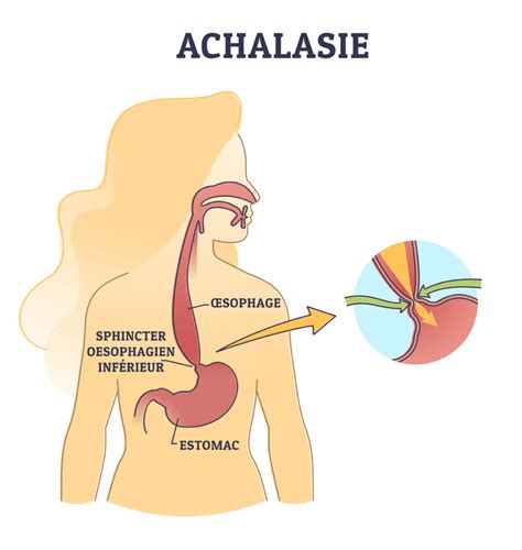 Achalasie Causes Sympt Mes Et Traitements Information Hospitali Re