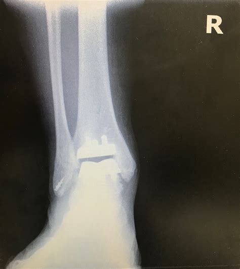 Debilitating Ankle Arthritis A Total Ankle Replacement May Be Your