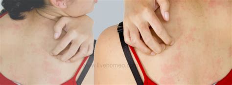 Skin Allergies Prevention Tips – Live Homeo