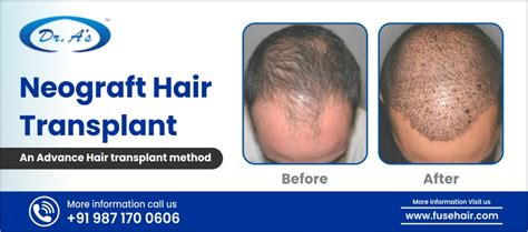 Neograft Hair Transplant An Advance Hair Transplant Method Fusehair