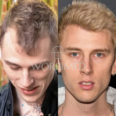 MGK Machine Gun Kelly Hair Transplant