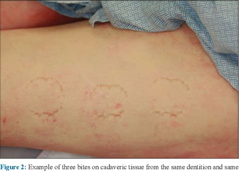 Human Bite Marks On Skin