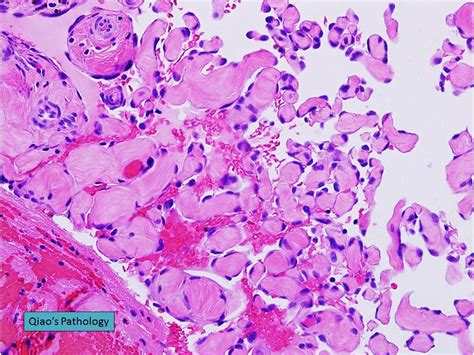 Qiao S Pathology Digital Intravascular Papillary Endothel Flickr