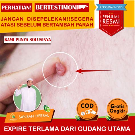 Obat Daging Tumbuh Di Kulit Salep Penghilang Daging Tumbuh Obat