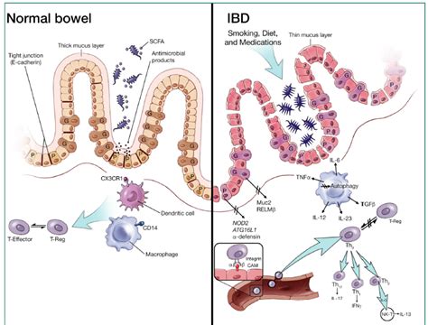 Enfermedad Inflamatoria Intestinal Gastro M Rida