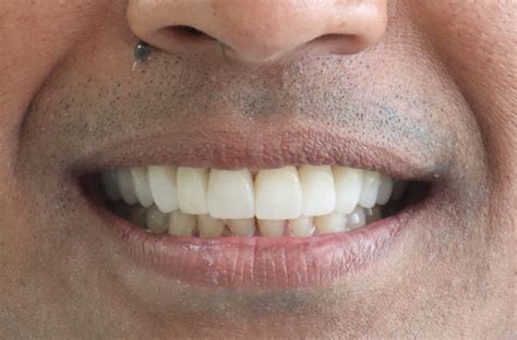 WORN DOWN TEETH? ⋆ WEAR TEETH - FIXED WITH CROWNS