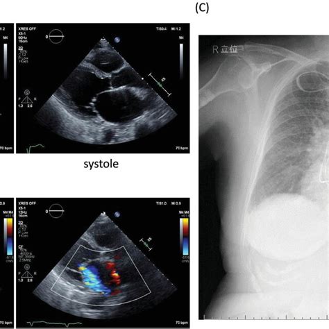 A Severe Left Ventricular Systolic Dysfunction Echocardiographic