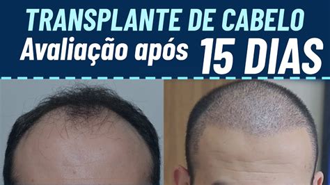 Avaliação 15 dias após o transplante capilar YouTube