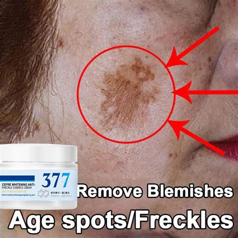 Dark Spot Remover Face Whitening Cream Freckles Removal Cream G