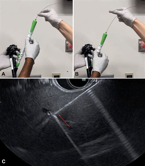 Eus Guided Liver Biopsy Using A Novel Hydrostatic Stylet Technique