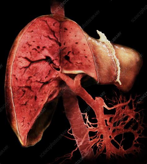 Liver Stock Image P Science Photo Library