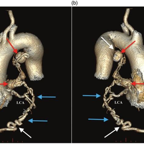 Preoperative Computed Tomography Angiography Demonstrating A Anterior Download Scientific