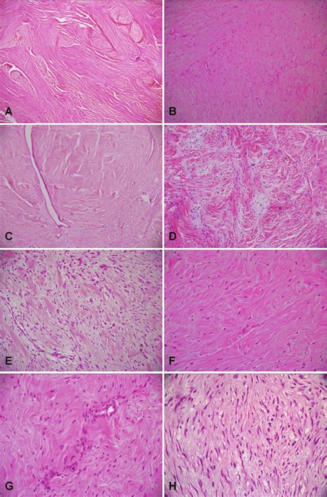 Photomicrographs Showing Tumor Cells In Long Intersecting Fascicles A