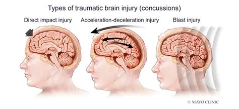 Horizon Tbi Brain Center Neurology Tbi Testing