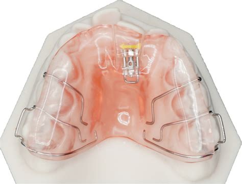 Crossbite Screw Protec Dental