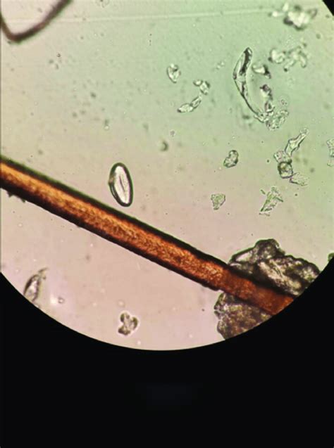 Eggs Of Enterobius Vermicularis Download Scientific Diagram