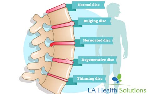 What Is Degenerative Disc Disease? | LA Health Solutions