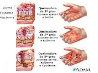ePORTUGUÊSe Queimou se Saiba como agir e principalmente o que NÃO fazer