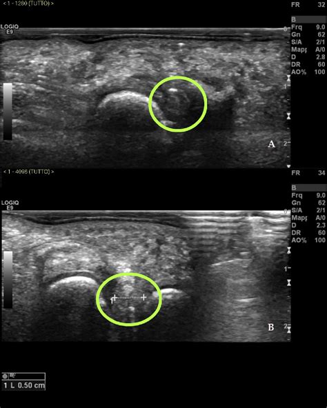 Figure From Ultrasound Guided Radiofrequency Ablation Of Mortons