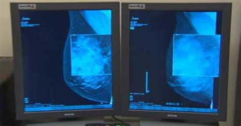 New 3d Mammogram Technology Used At Mgh Cbs Boston