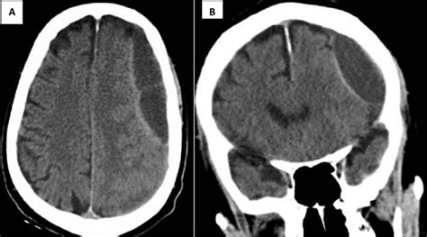 Brain Computed Tomography CT Showing Subdural Hematoma Of 2 6 Cm In