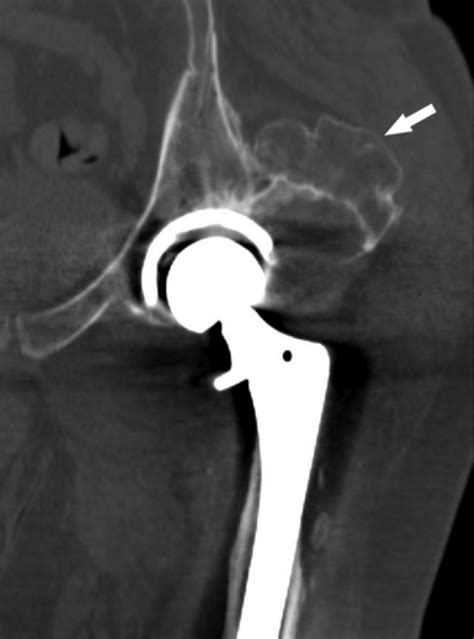 Heterotopic Ossification In A Patient With A Left Total Hip Prosthesis Download Scientific