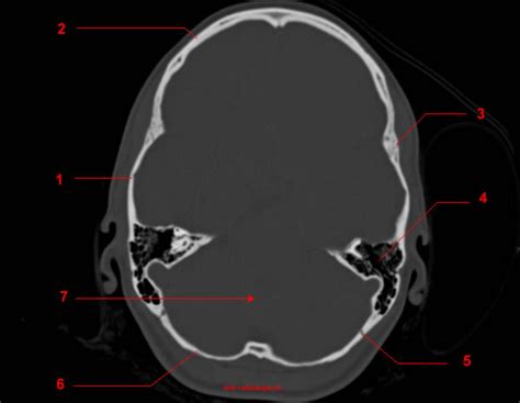 Skull CT anatomy - W-Radiology