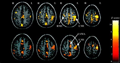 Lack Of Sex Effect On Brain Activity During A Visuomotor Response Task