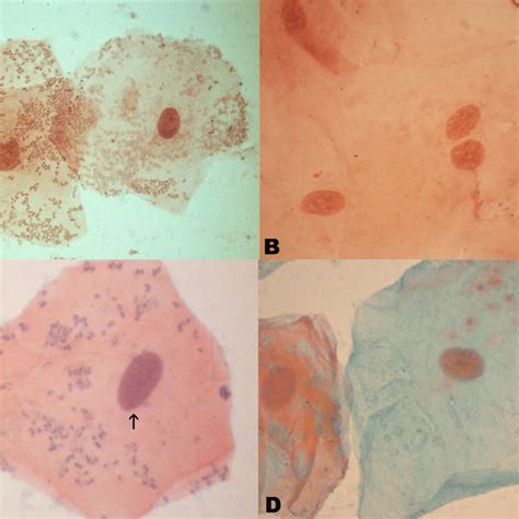 Figure A Phothomicrograph Of Cytological Smears With Cells Positive Download Scientific