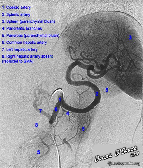 Splenic Artery Anatomy