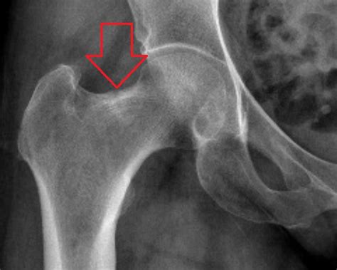 Ap Radiograph Of The Hip Demonstrating A Stress Fracture Of The Tension