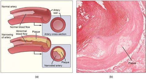 How Hypertension And Aging Impact Artery Walls New Findings On