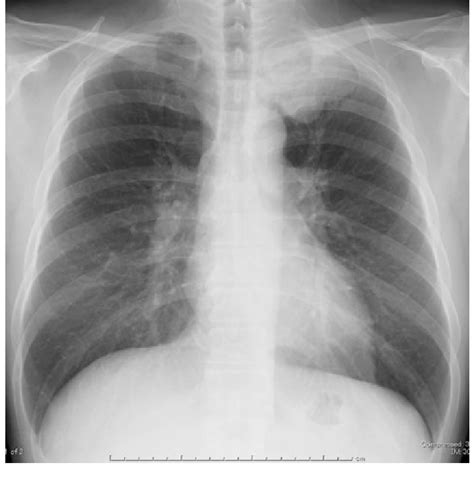 Chest X Ray At Admission Revealed A Bulky Mass In The Apex Of The Left Lung Download