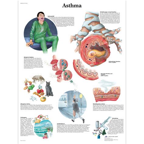 Understanding Asthma Chart Poster Laminated Ubicaciondepersonas Cdmx Gob Mx