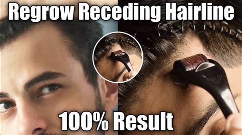 Regrow Hairline How To Regrow Receding Hairline Dermaroller