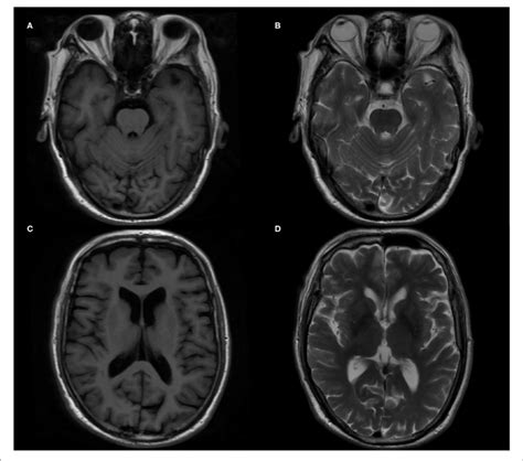 Brain Magnetic Resonance Imaging Mri In The Patient Ac Download Scientific Diagram