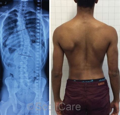 Reduction Of Severe Scoliosis In A 14 Year Old Male Patient