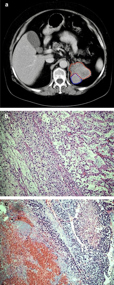 Female Patient 64 Years A Computed Tomography Showing An 8 Cm Download Scientific Diagram