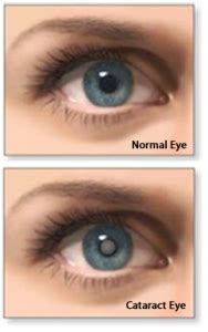 cataract-before-after