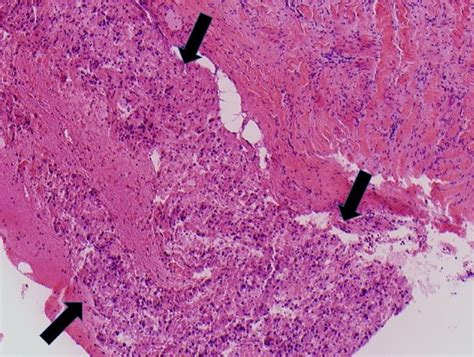 A Rare Case Of Vena Cava Tumor Thrombus Associated With Epithelioid