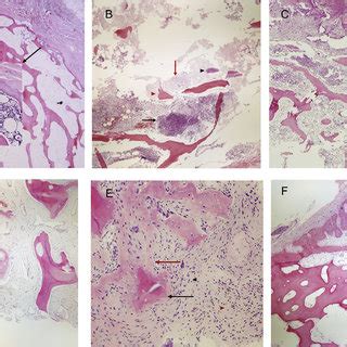 (PDF) Diagnosing Osteomyelitis: A Histology Guide for Pathologists