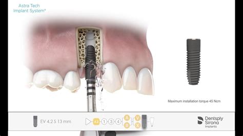 Implant Installation Astra Tech Implant System Ev Youtube