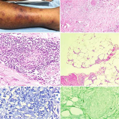 Clinical Photograph Of Skin Lesion A Histopathological Examination