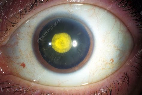 Congenital Rubella Cataract Stock Image C0261057 Science Photo