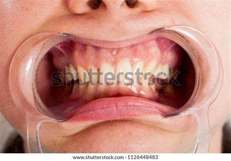 112 Supplying Lips Cheeks Images Stock Photos Vectors Shutterstock