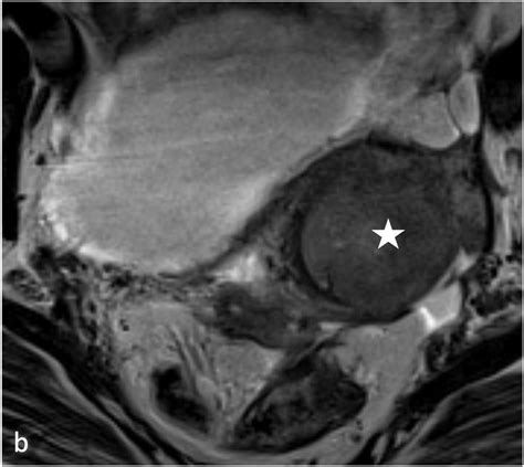 Endometrial Cancer With Peritoneal Metastasis Mimicking Deep Pelvic