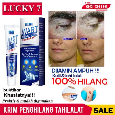 Jual Sumifun Wart Remover Original Eelhoe Krim Ampuh Menghilangkan Tahi