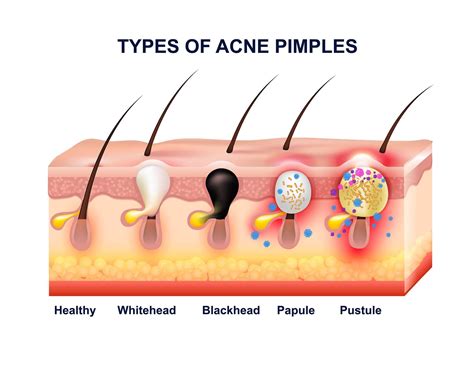 Skin Acne Anatomy Composition - Organic Elements Wellness Spa