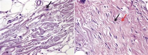 Nterface Between Dermis And Subcutaneous Tissue Three Months A Download Scientific Diagram